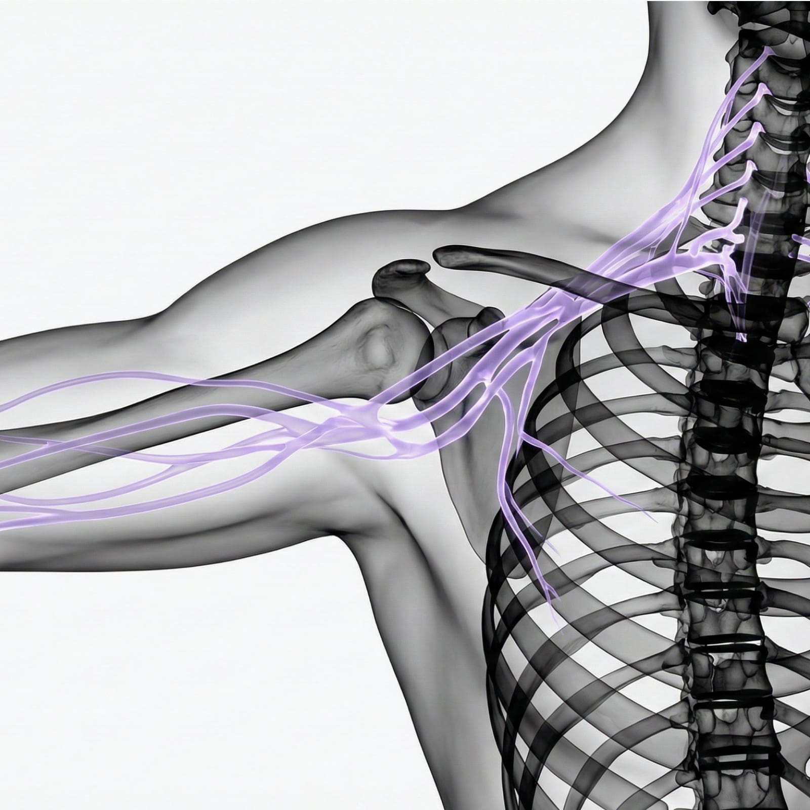 MR Plexus brachialis