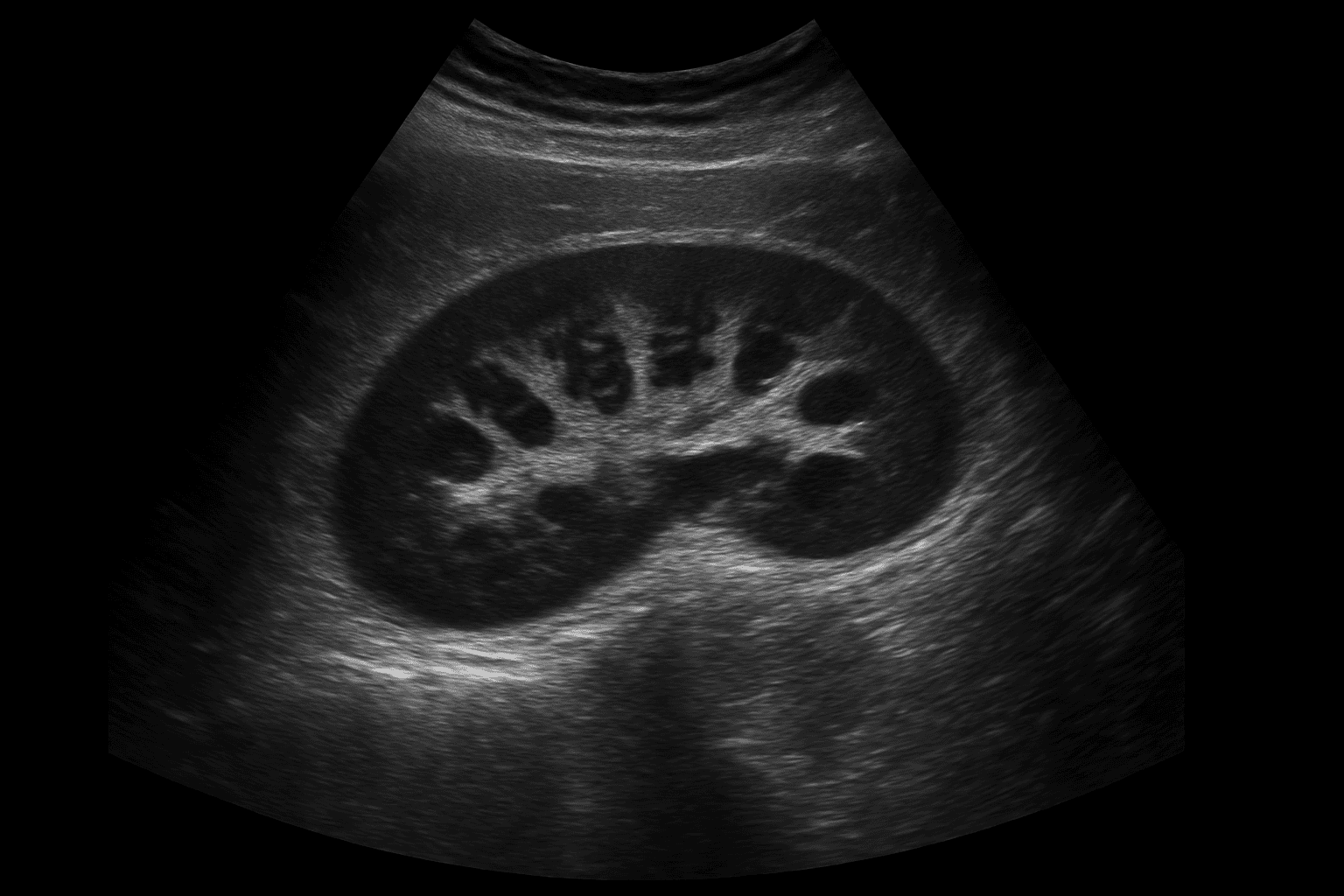 En ultraljudsundersökning eller sonografi är en säker, smärt- och strålningsfri metod som ger detaljerade bilder av kroppens organ, leder, kärl och mjukdelar. Ultraljud används för undersöka alla delar av kroppen som innehåller vätska och inte skyms av ben eller luft. Undersökningen kan upptäcka avvikelser som inte alltid syns på vanlig slätröntgen.