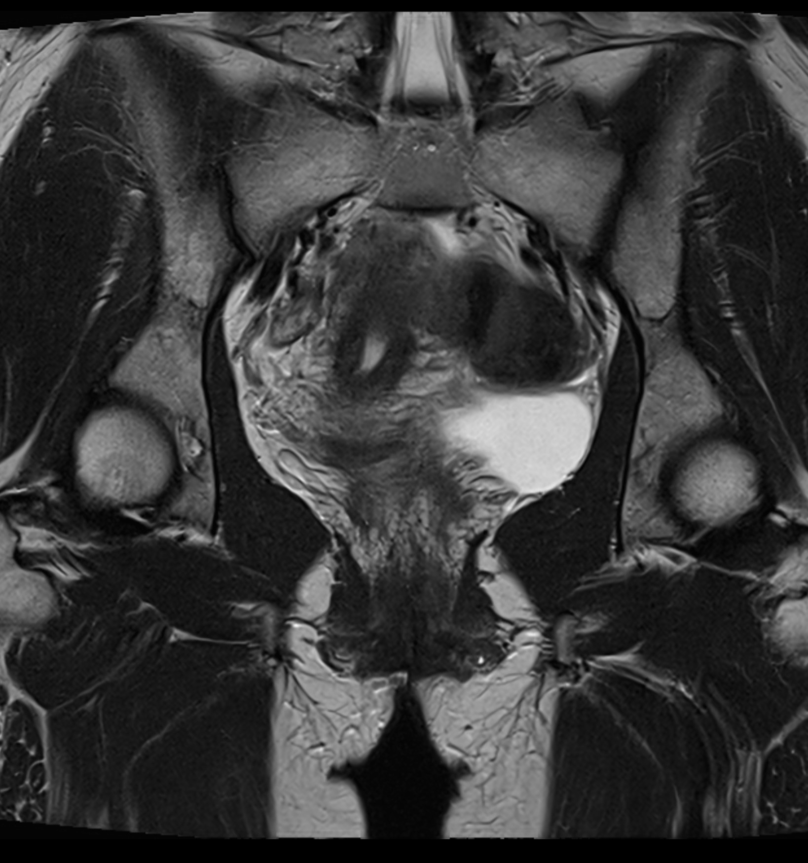 MRI Pelvic