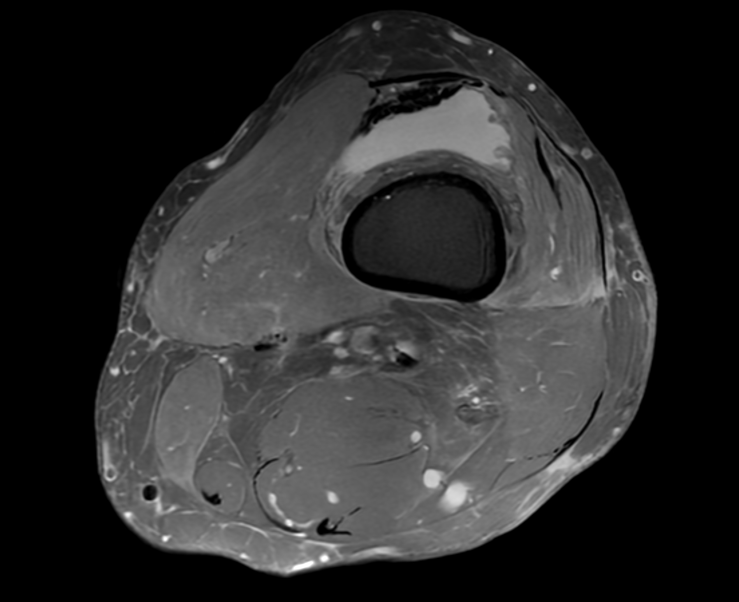 magnetröntgen av knä