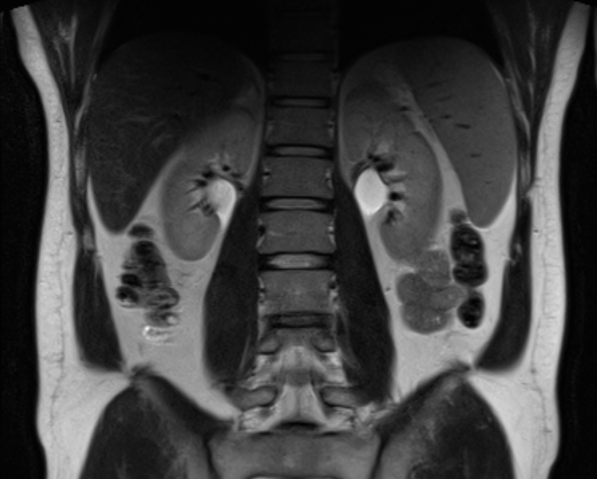 A kidney MRI