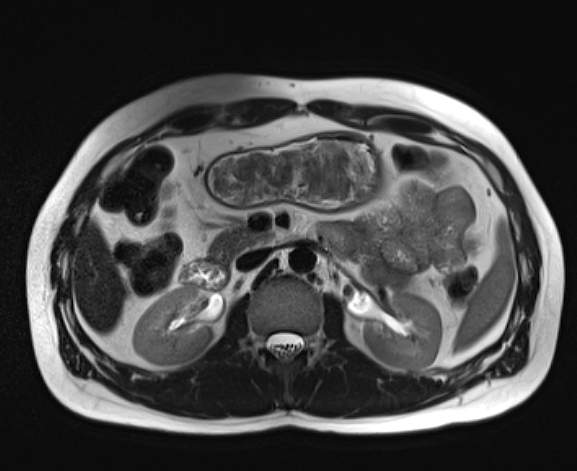 MRI Kidneys