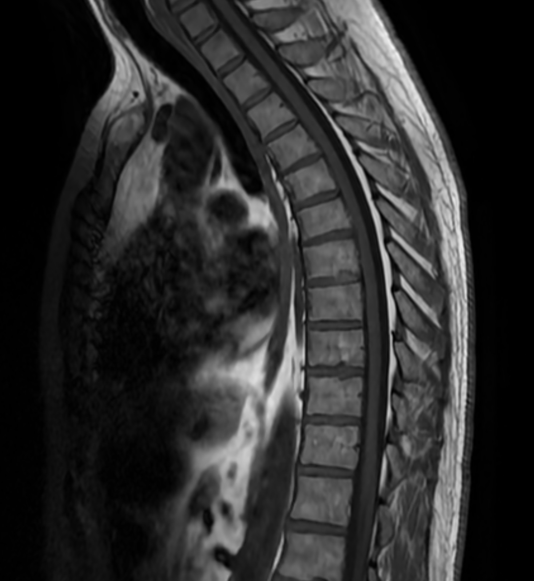 MR bröstrygg som visar thorakal ryggrad och ryggmärg