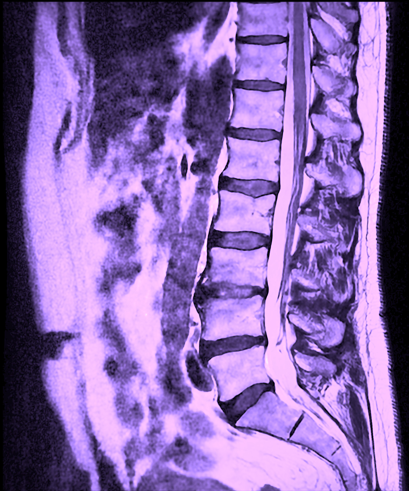 Vad visar en MR-undersökning av ländryggen?