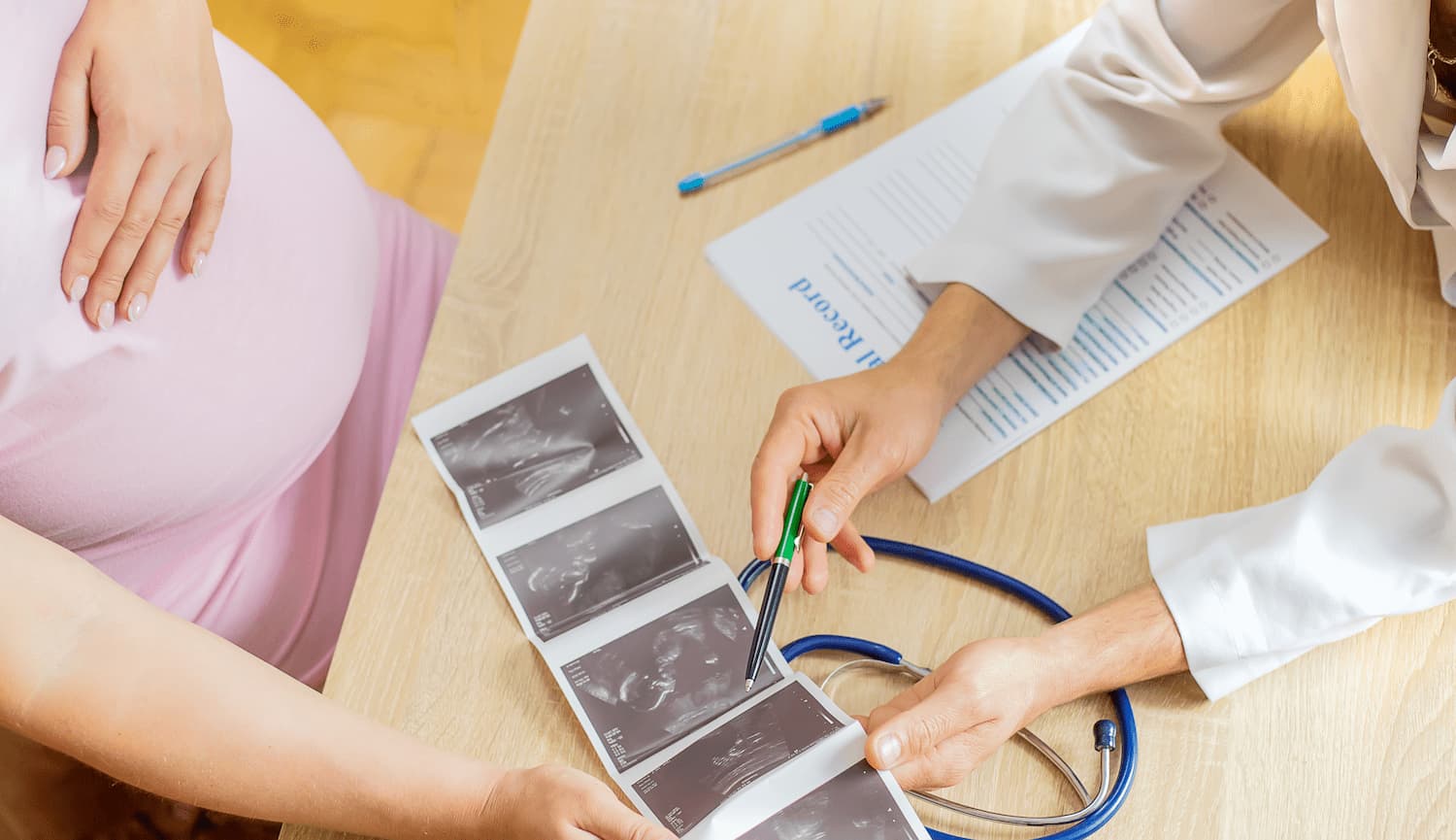 Turners syndrom – upptäcks ofta vid NIPT-test