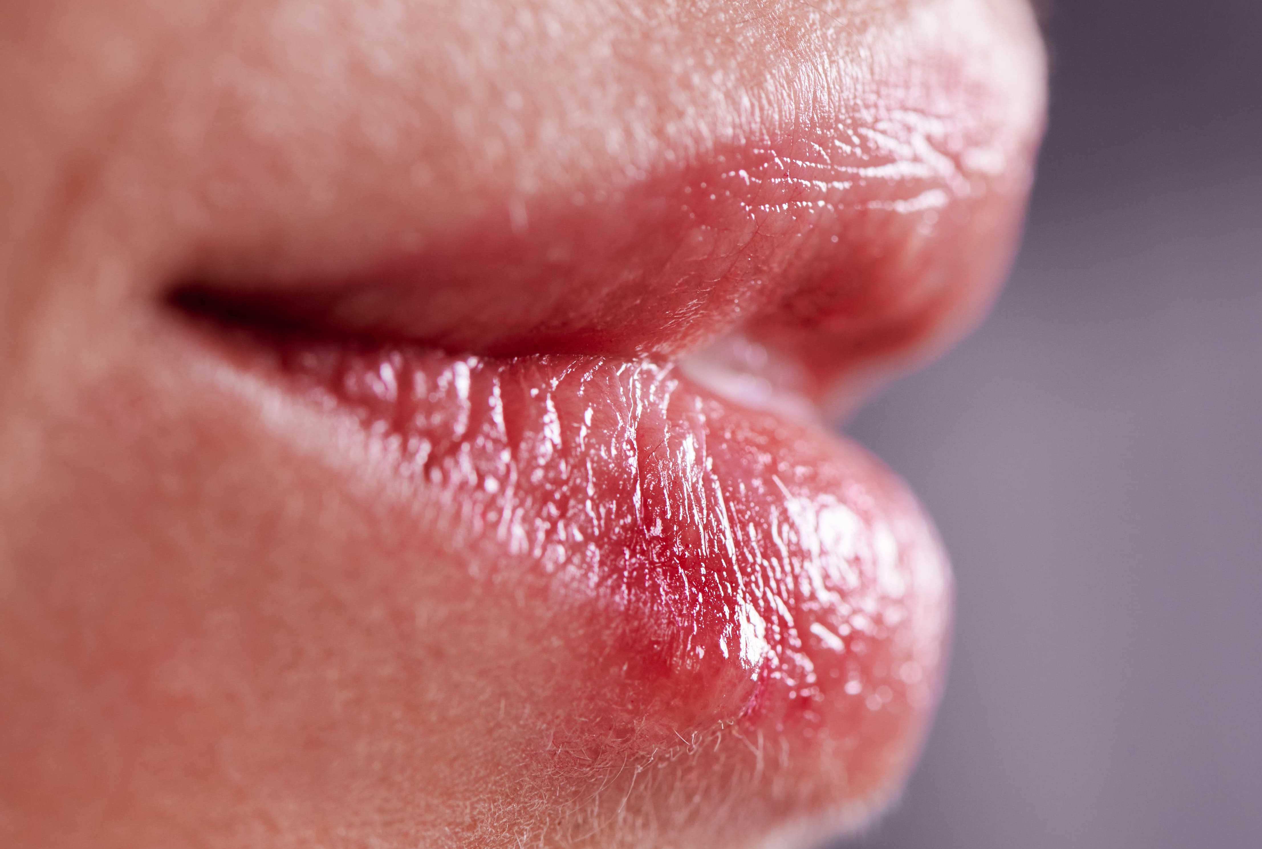 herpes cold sores