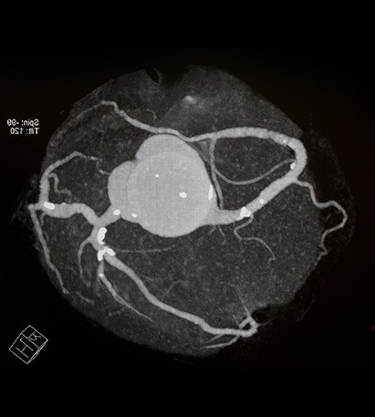 CT heart coronary calcium score