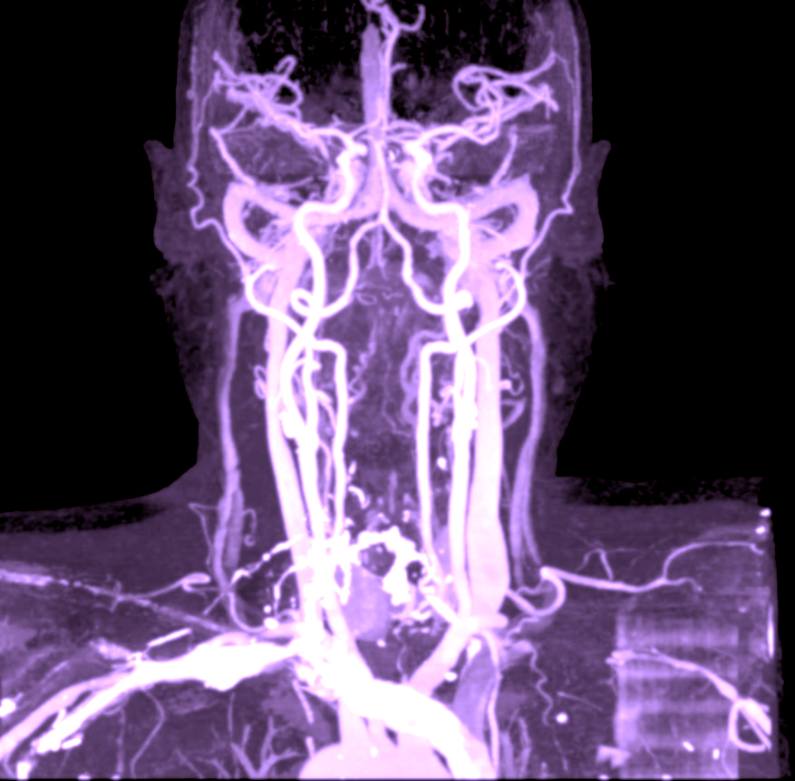 CT neck vessel angio