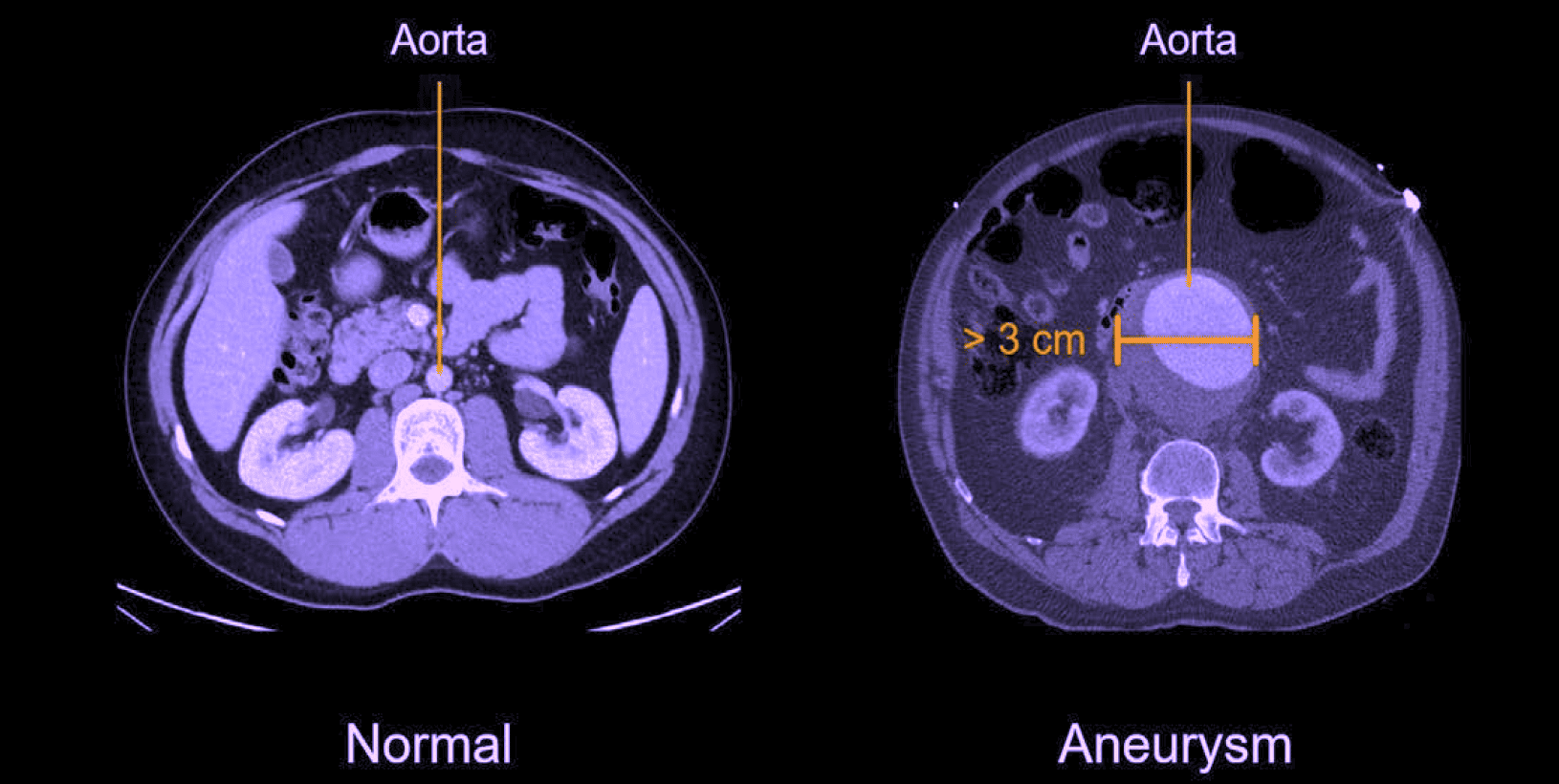 CT aorta