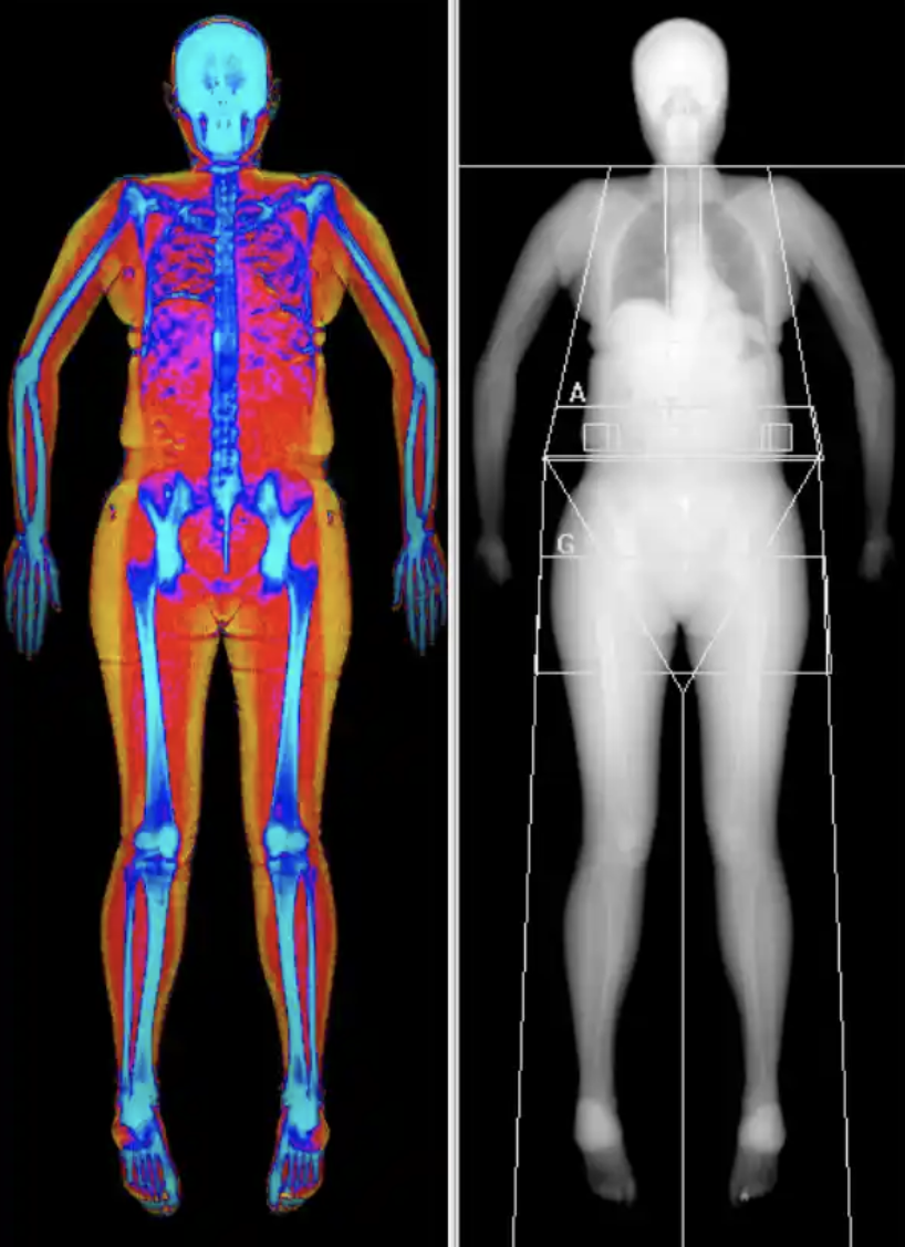 DEXA body scan