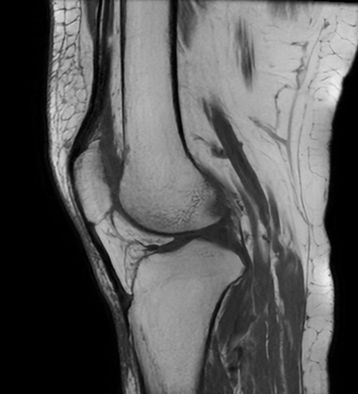 MR knä (tvärsnitt)