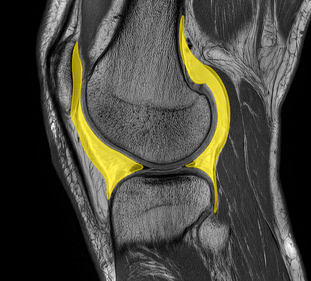 MR som påvisar hydrops i knät