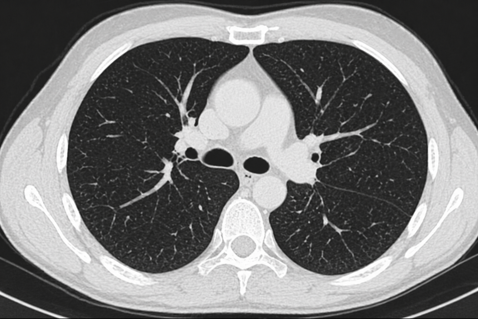 CT lungor datortomografi
