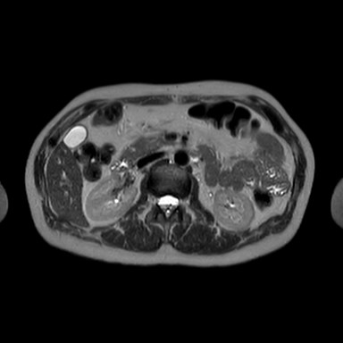 MR Pancreas