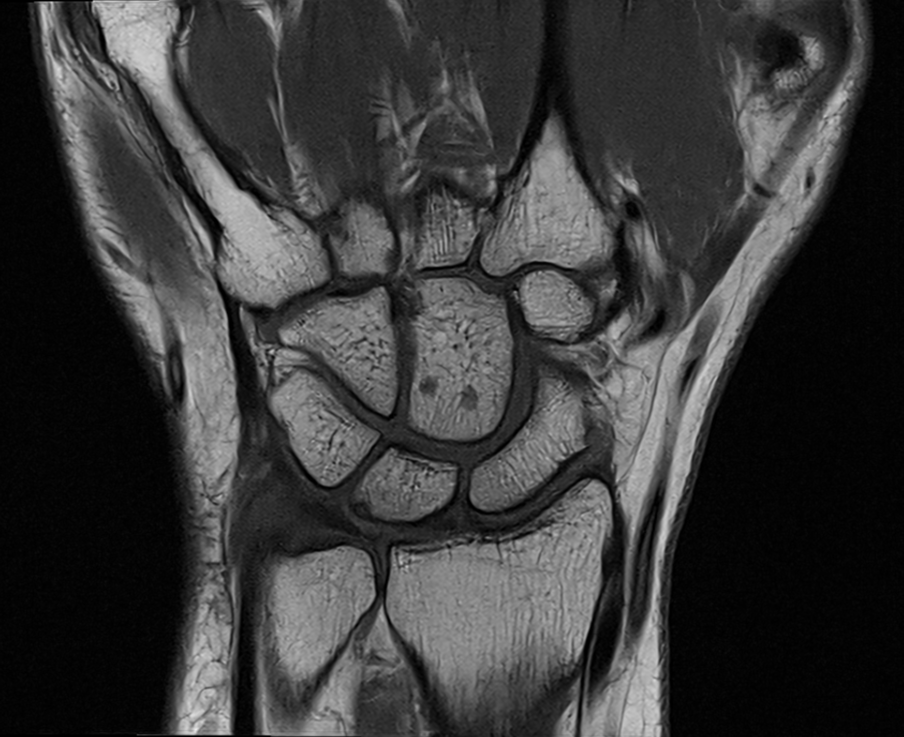 MRI image of the wrist