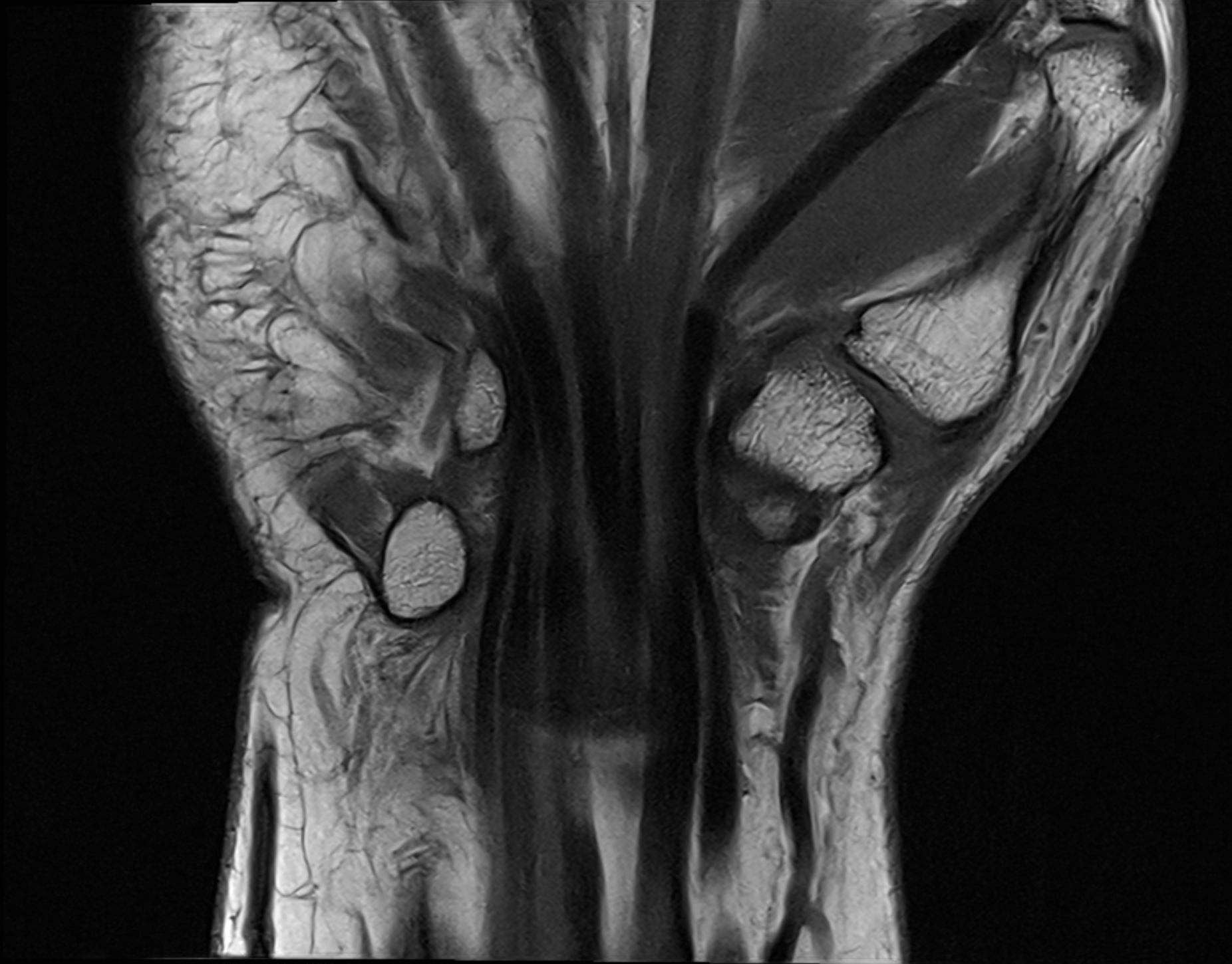 MR image of the wrist in a different image plane showing the carpal bones and surrounding soft tissues.
