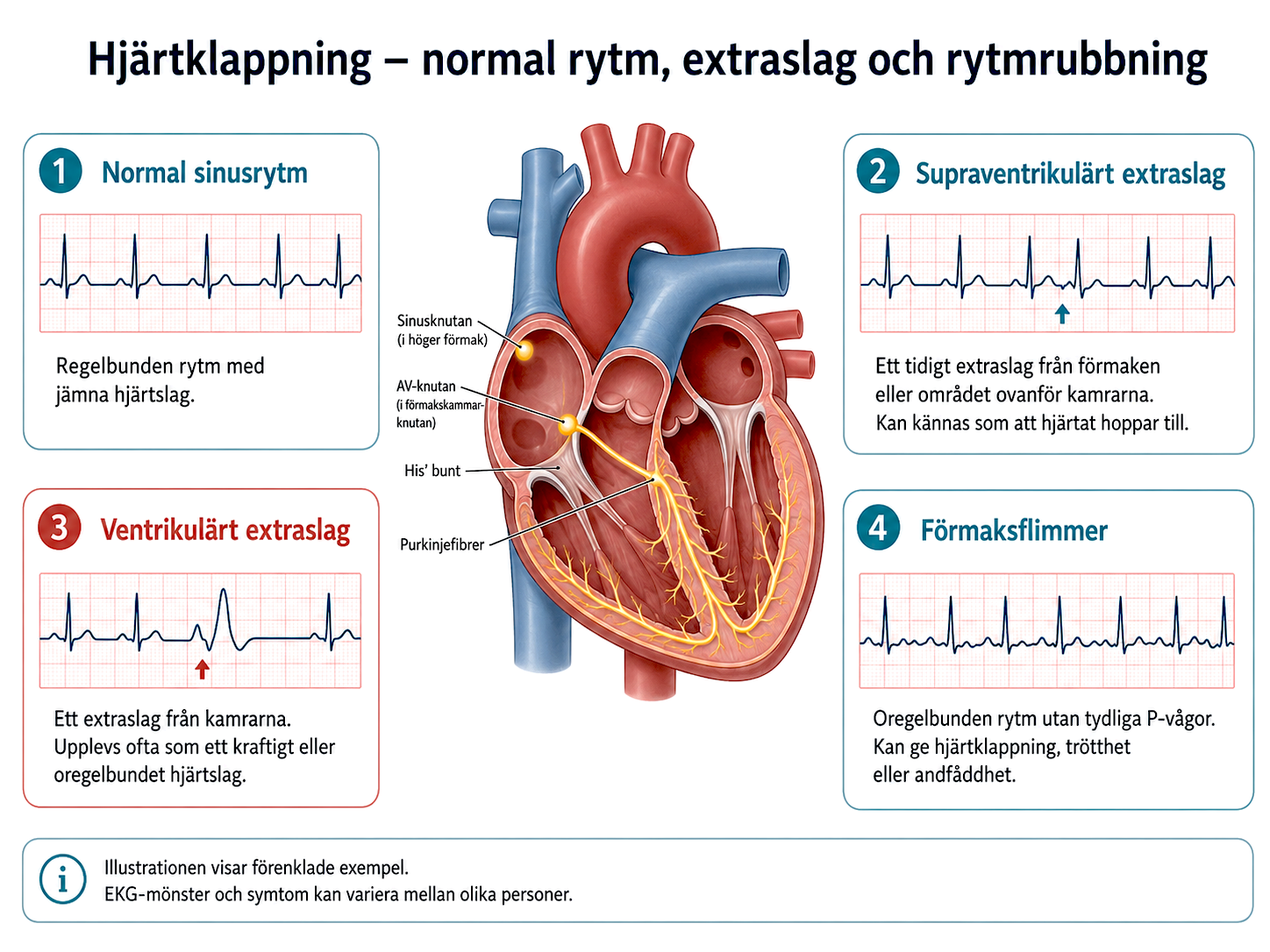 normal sinusrytm och ventrikulärt extraslag