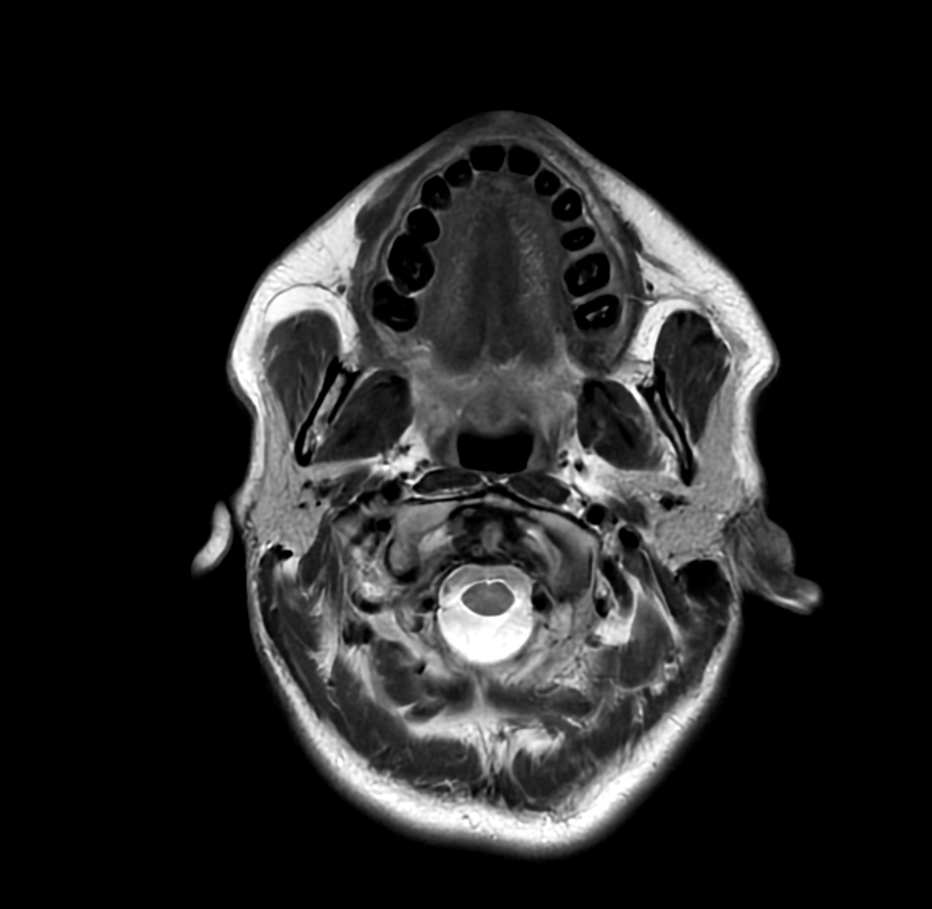 Axial MRI scan of the lower face and upper neck showing the oral cavity, jaw area, pharynx, and soft tissues.