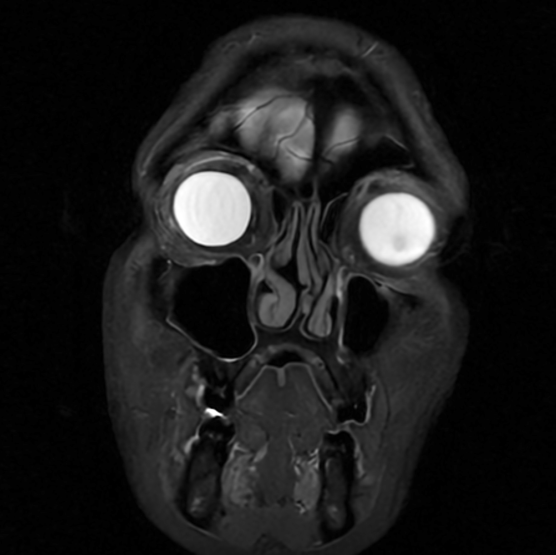 Coronal MRI scan of the face showing the orbits, sinuses, nasal cavity, and surrounding soft tissues.