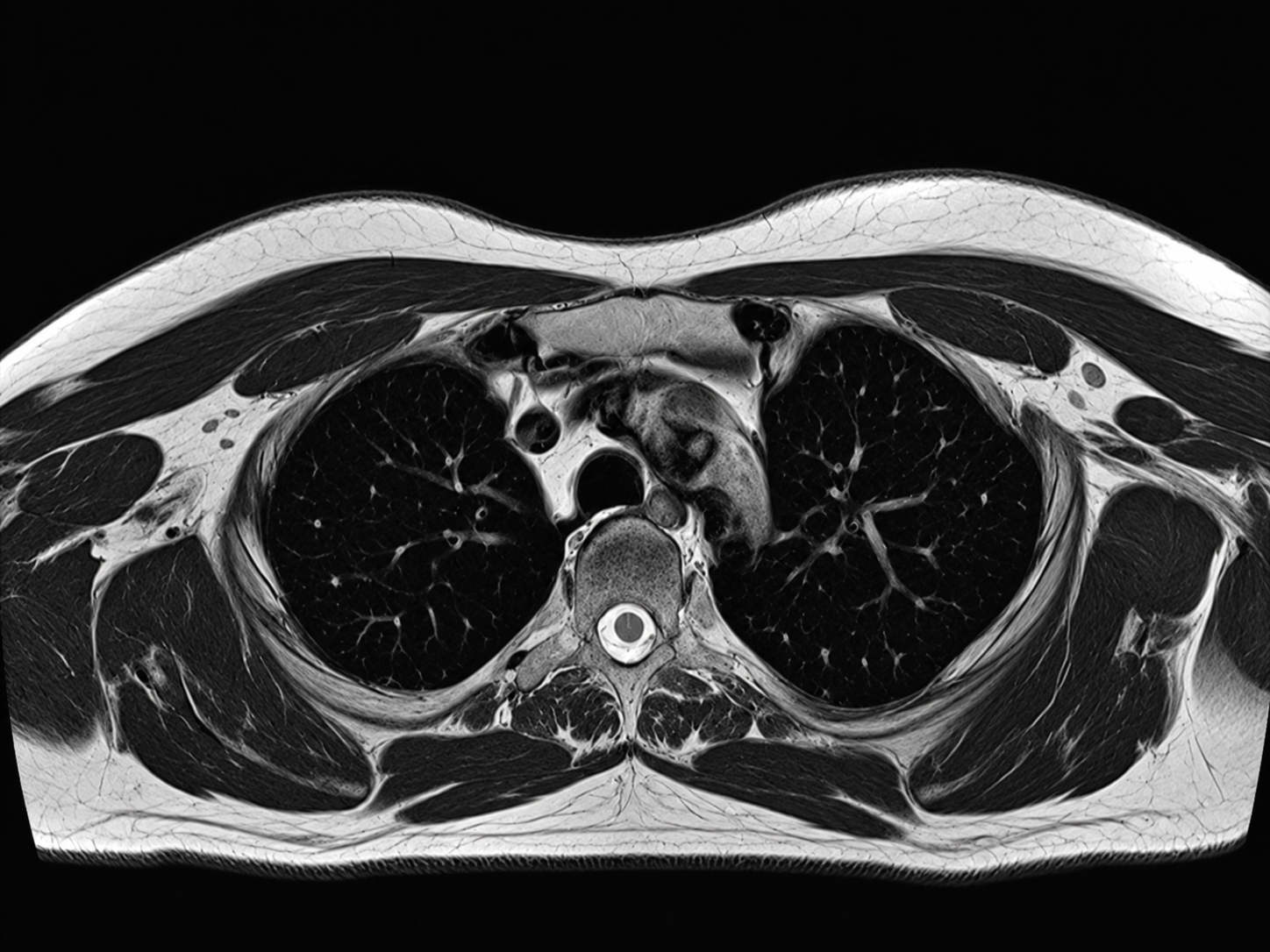 Axial MRI image of the chest showing the lungs, mediastinum, spine, chest wall, and surrounding soft tissues.