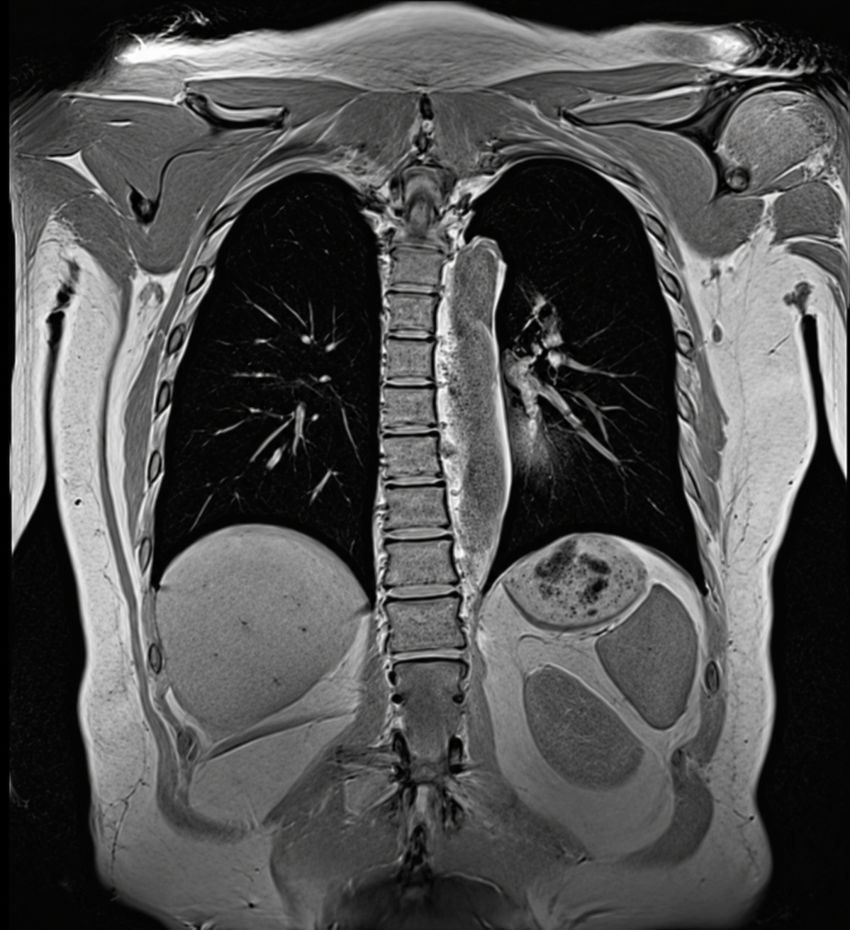 Coronal MRI image of the chest showing lungs, spine, mediastinum, chest wall, and upper abdominal organs.