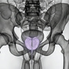 MRI Prostate