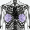 MRI Breasts