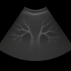 Ultrasound abdominal aorta