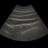 Ultrasound abdominal wall