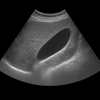 Ultrasound Gallbladder