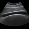 Ultrasound achilles tendon