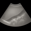 Ultrasound Liver Elastography