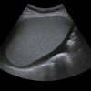 Ultrasound Spleen