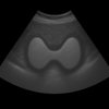 Ultrasound Thyroid