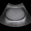Ultrasound Testicles