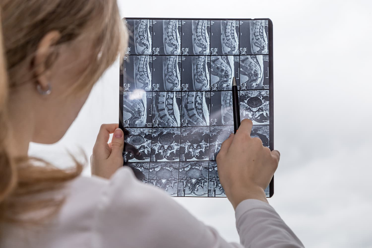 What Do the Terms in Your Spinal MRI Report Mean? A Patient Guide