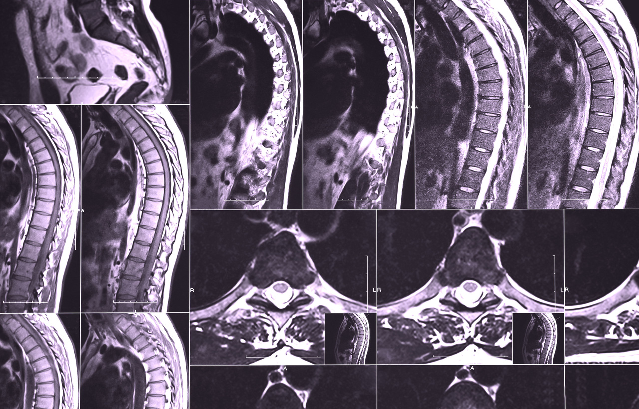 Myelitis (Spinal Cord Inflammation)
