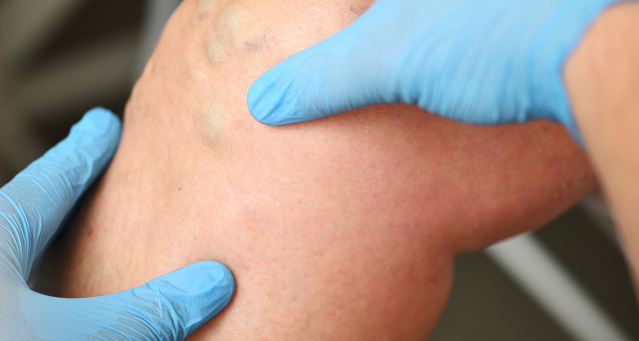 Knee pain? Here are the most common knee injuries – and when an MRI is needed