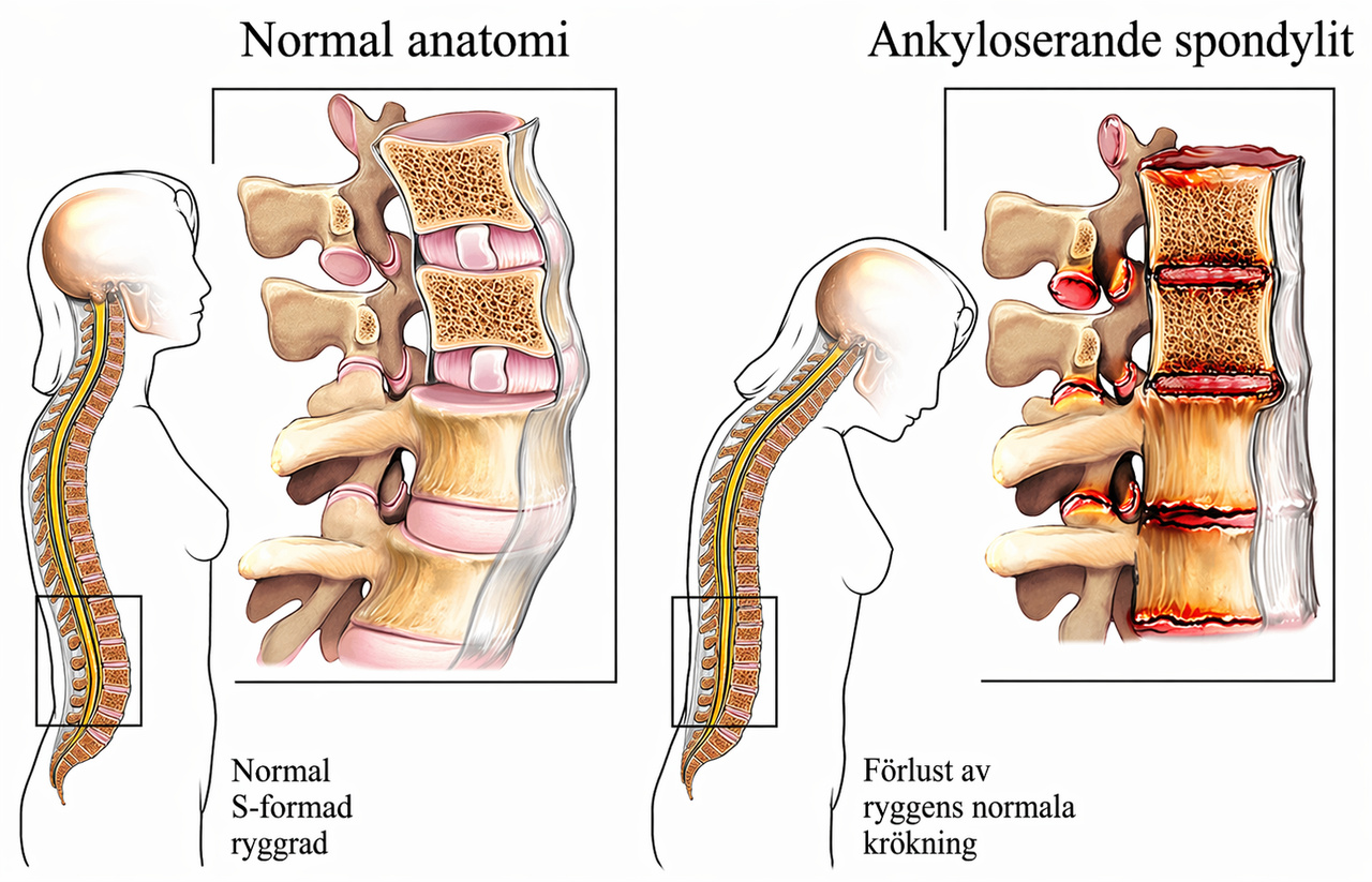 Ankylosing Spondylitis (AS)