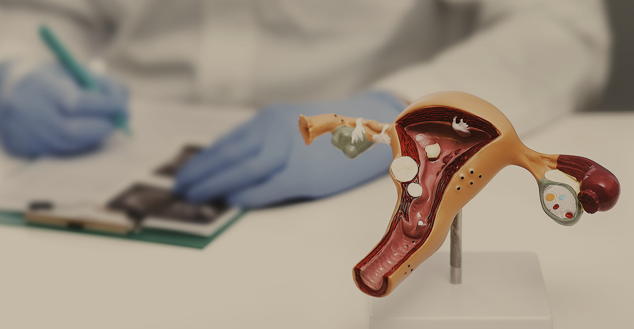 Ovarian cancer