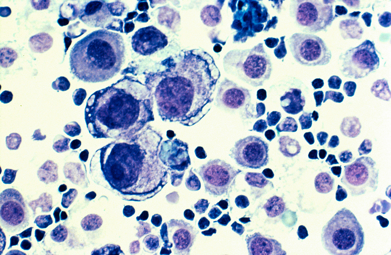 Myelom