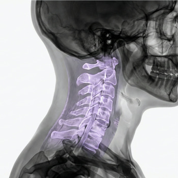 MRI Cervical spine