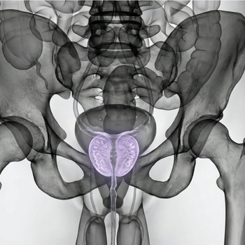 MRI Prostate