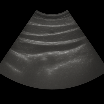 Ultrasound abdominal wall