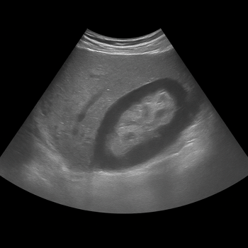 Ultrasound Kidneys