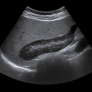 Ultrasound Pancreas