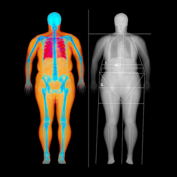Bone density measurement