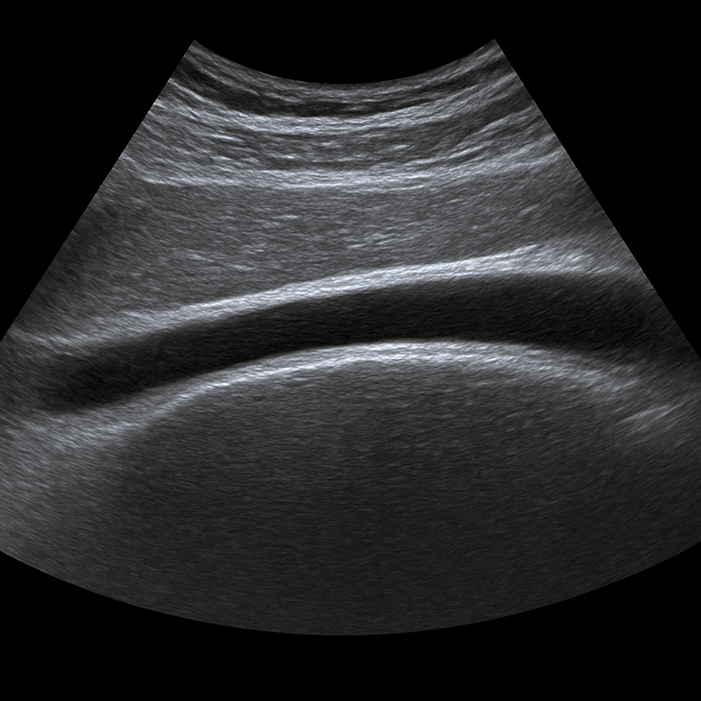 Ultrasound achilles tendon