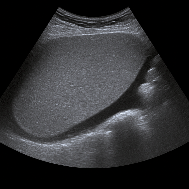 Ultrasound Spleen