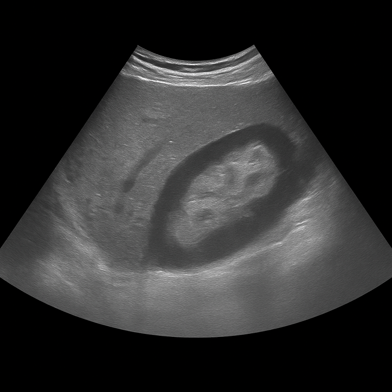 Ultrasound Kidneys